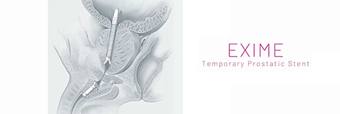 EXIME Temporary Prostatic Stent